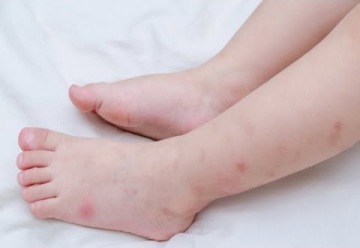 Štípance od štěnice poznáte podle charakteristických rysů – jedním z nich je například typické pokousání do trojúhelníku.