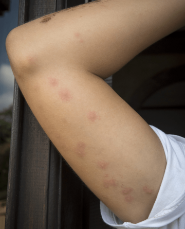 Pro poštípání štěnicemi je typické poštípání v řadě nebo do trojúhelníku. Štěnice většinou nekousne jen jednou.